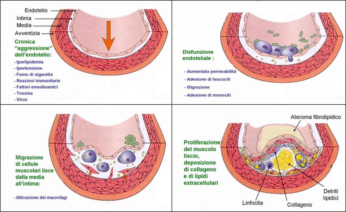 1a. Cenni sull'Aterosclerosi5