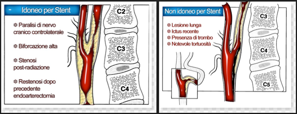 2. CAROTIDI E TRONCHI SOVRA-AORTICI2