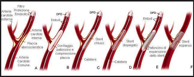 2. CAROTIDI E TRONCHI SOVRA-AORTICI3