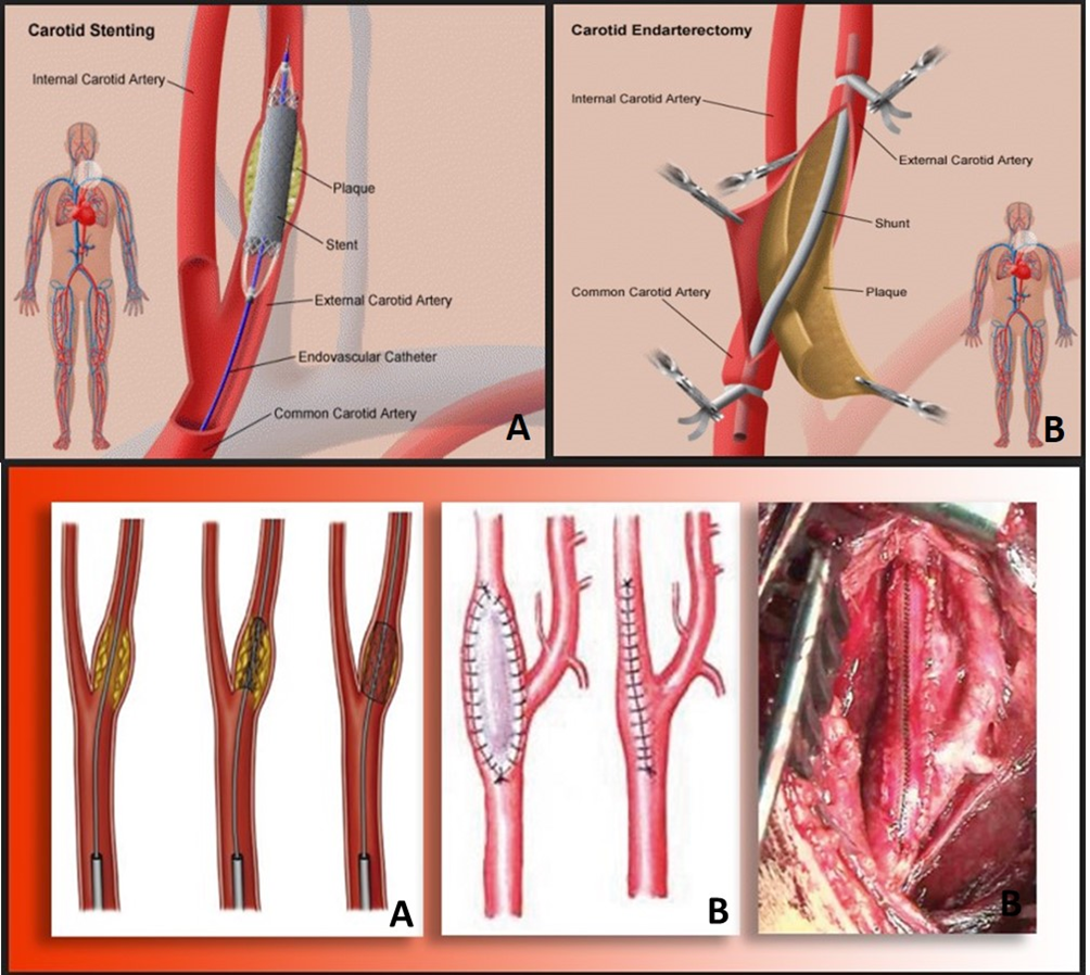 2. CAROTIDI E TRONCHI SOVRA-AORTICI_1