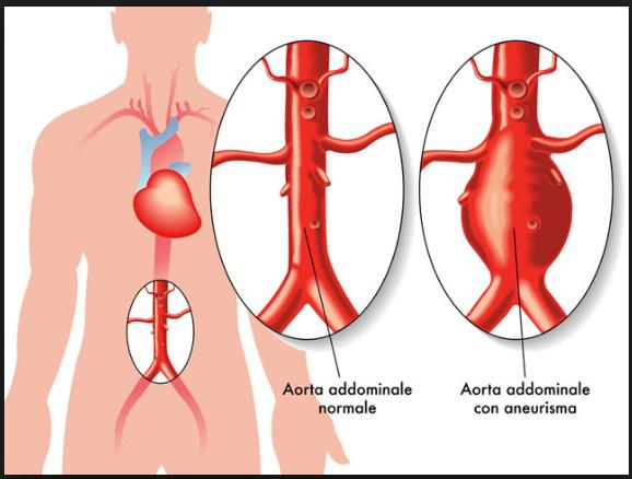 3. ANEURISMA AORTA2