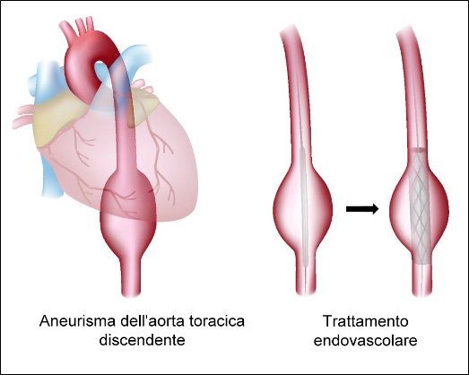 3. ANEURISMA AORTA4