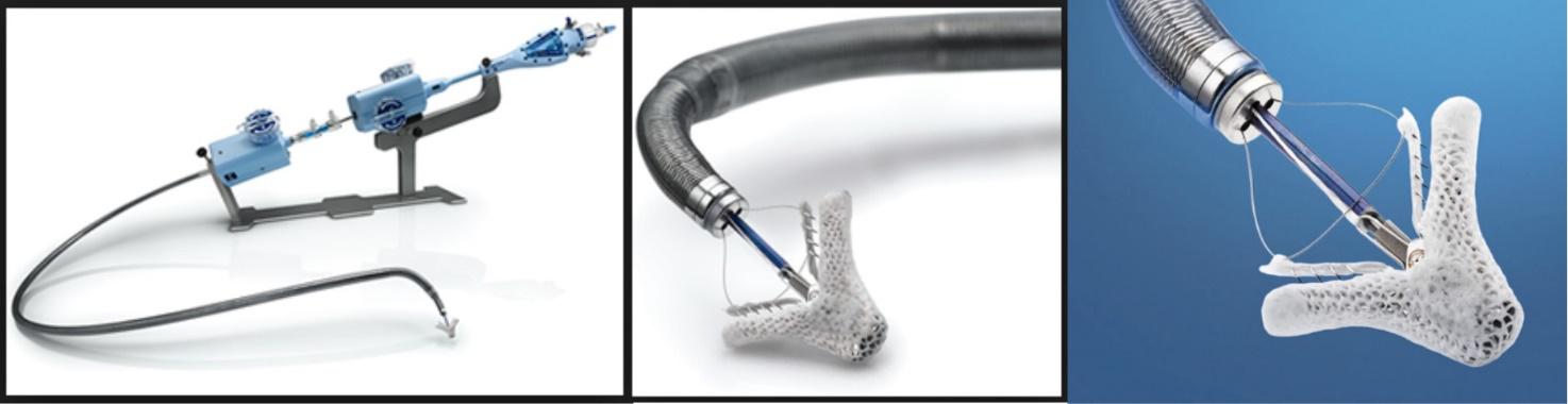 3. MITRACLIP1