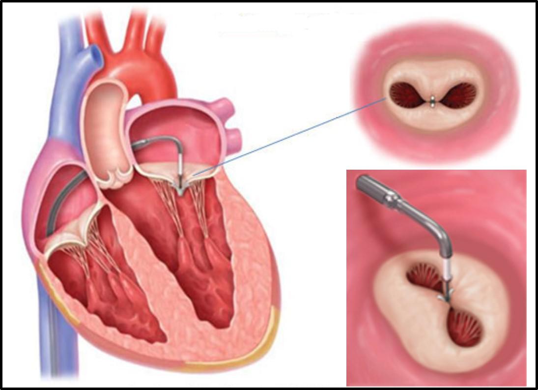 3. MITRACLIP2