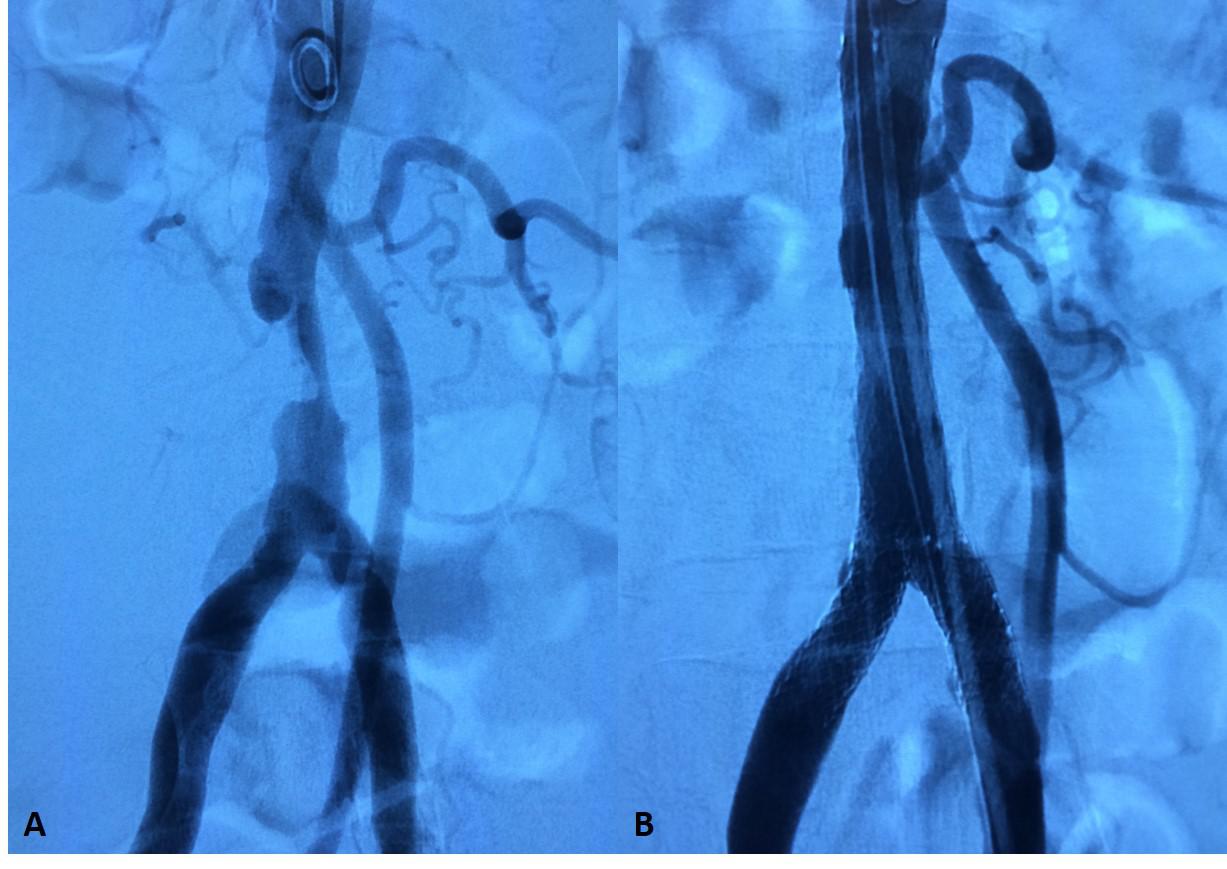 4. STENOSI AORTA ADDOMINALE1