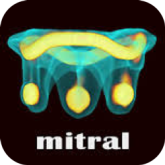 Valve-in-Valve-(Mitral)